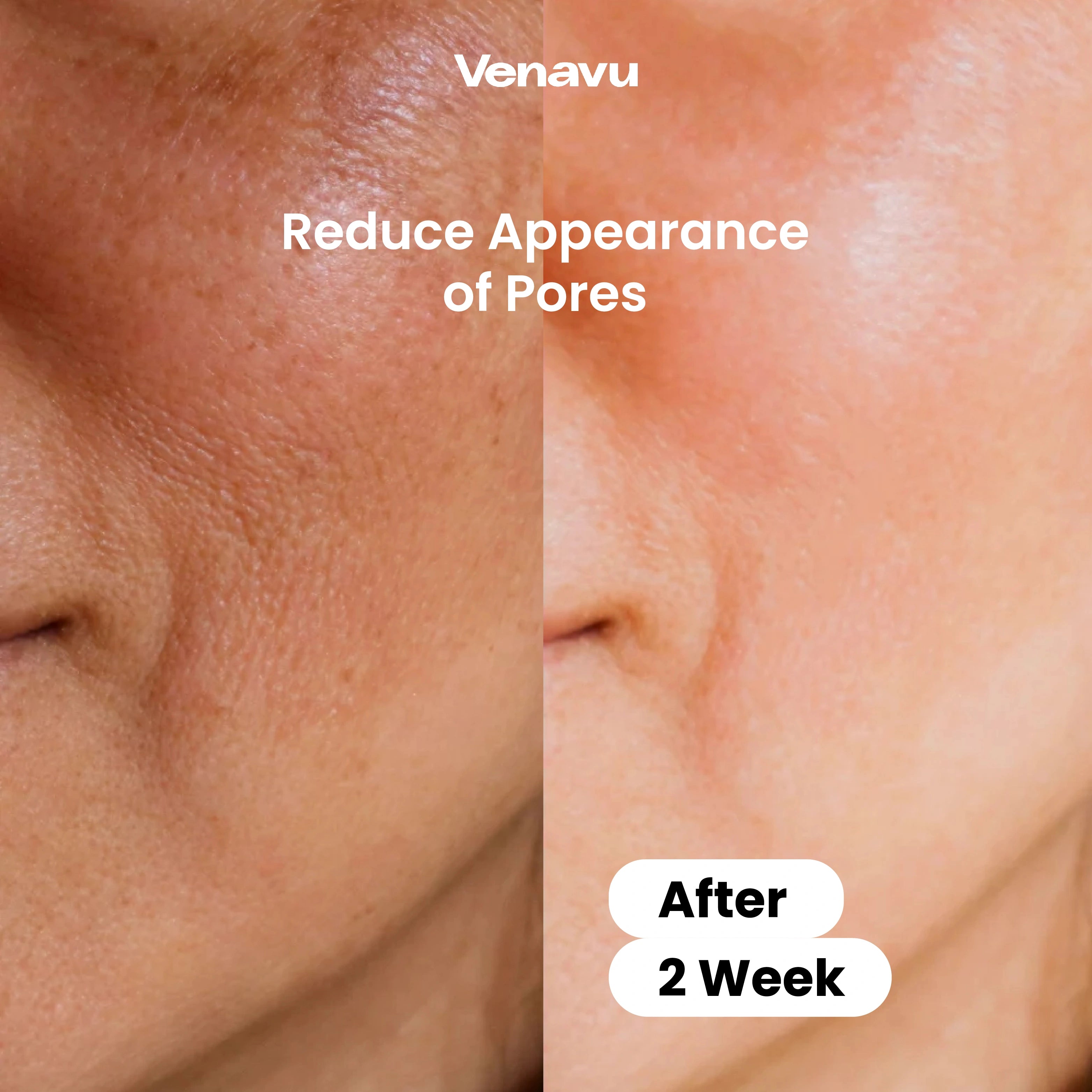 Venavu Micro Infusion System