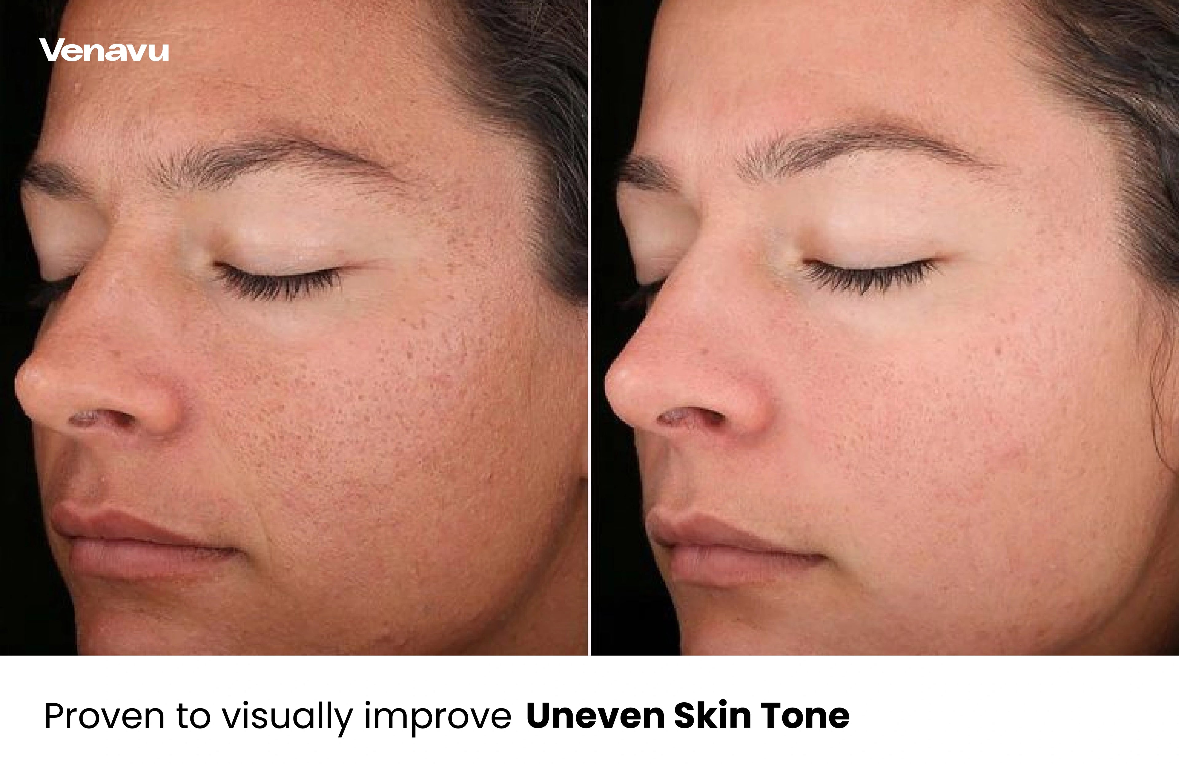 Venavu Micro Infusion System