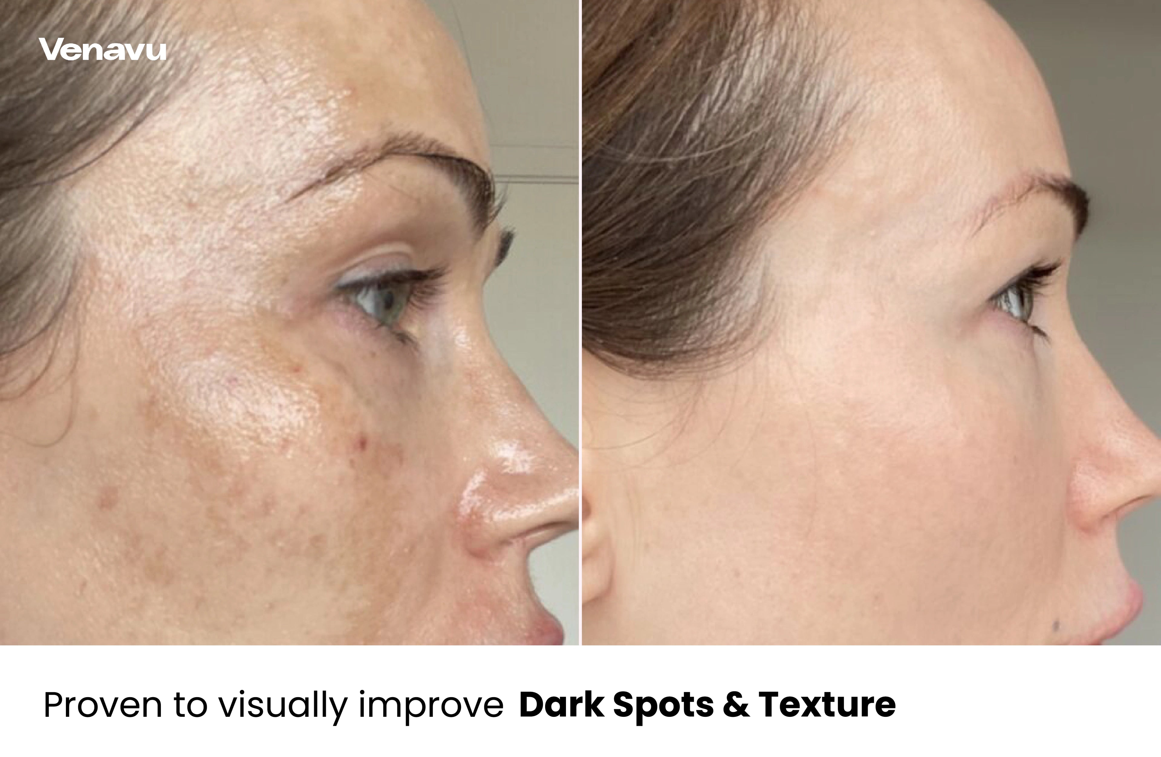 Venavu Micro Infusion System