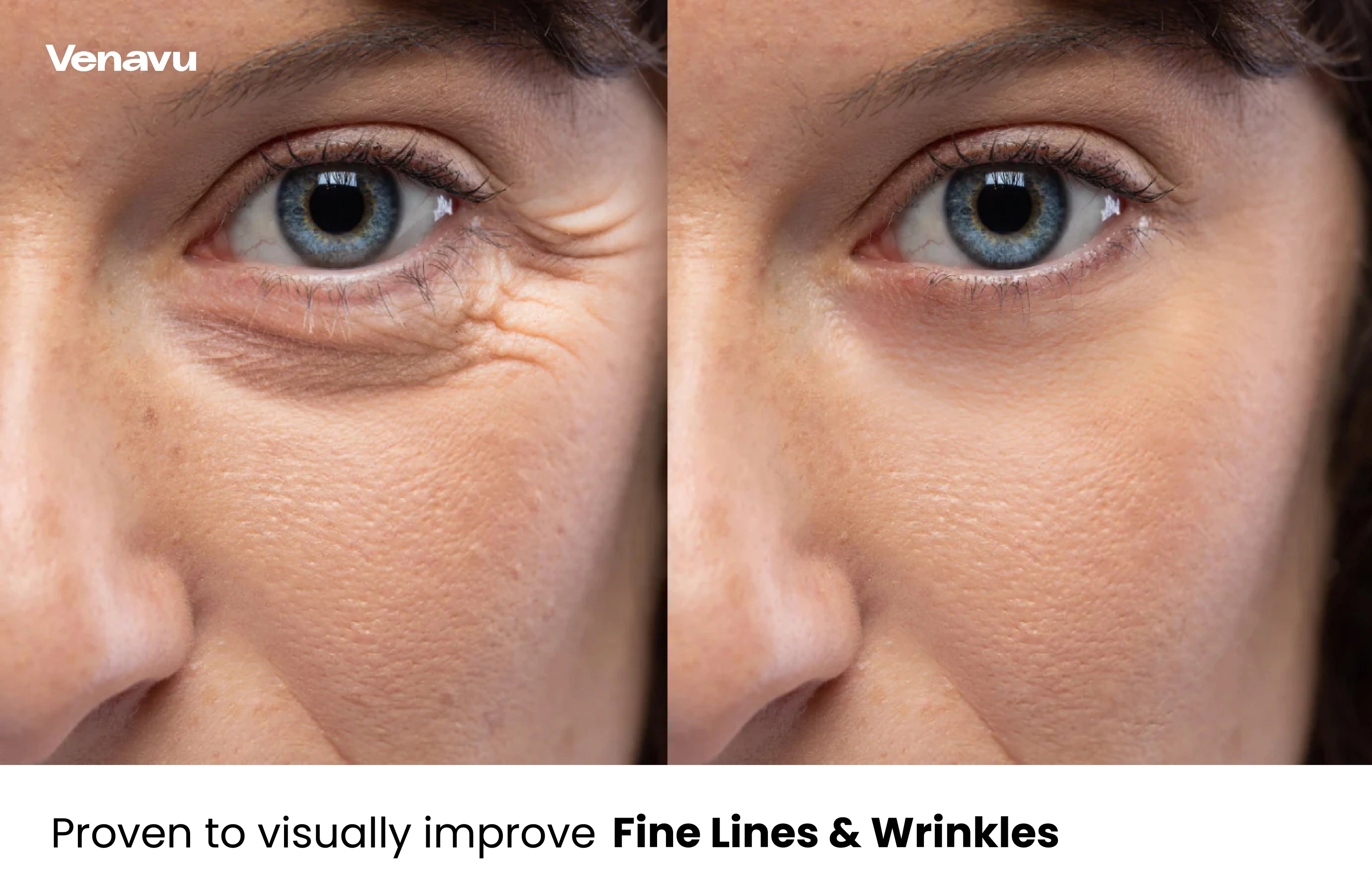 Venavu Micro Infusion System