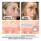 Venavu Micro Infusion System