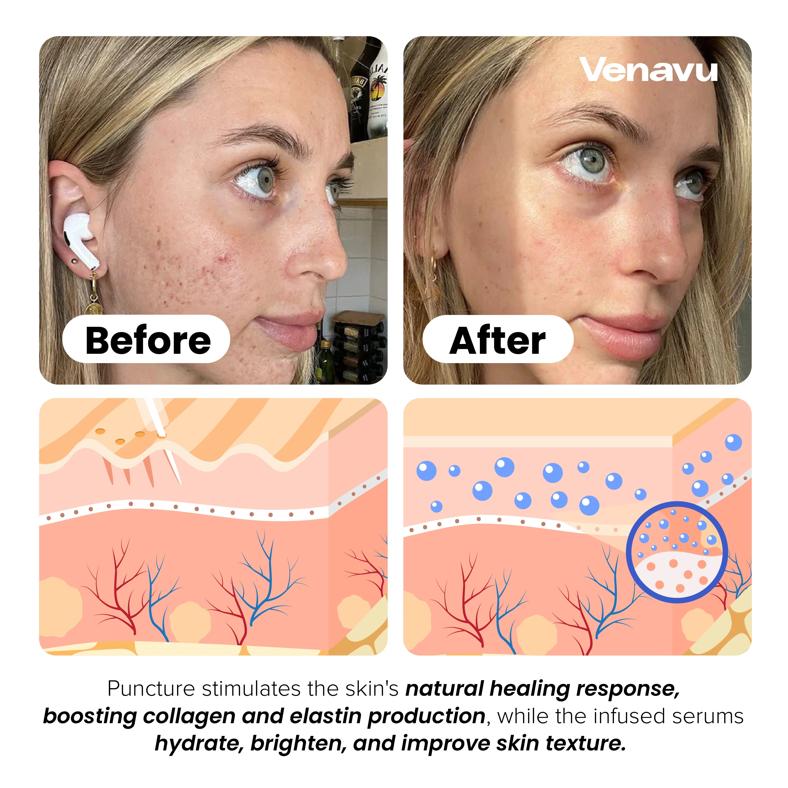 Venavu Micro Infusion System