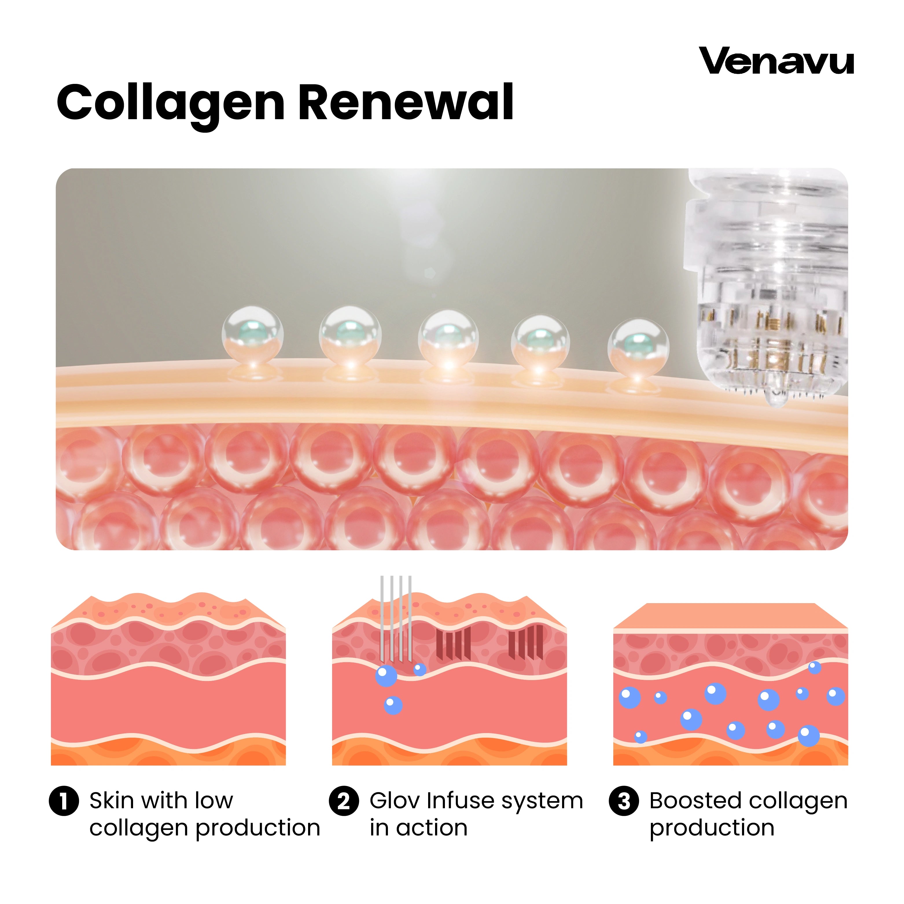 Venavu Micro Infusion System